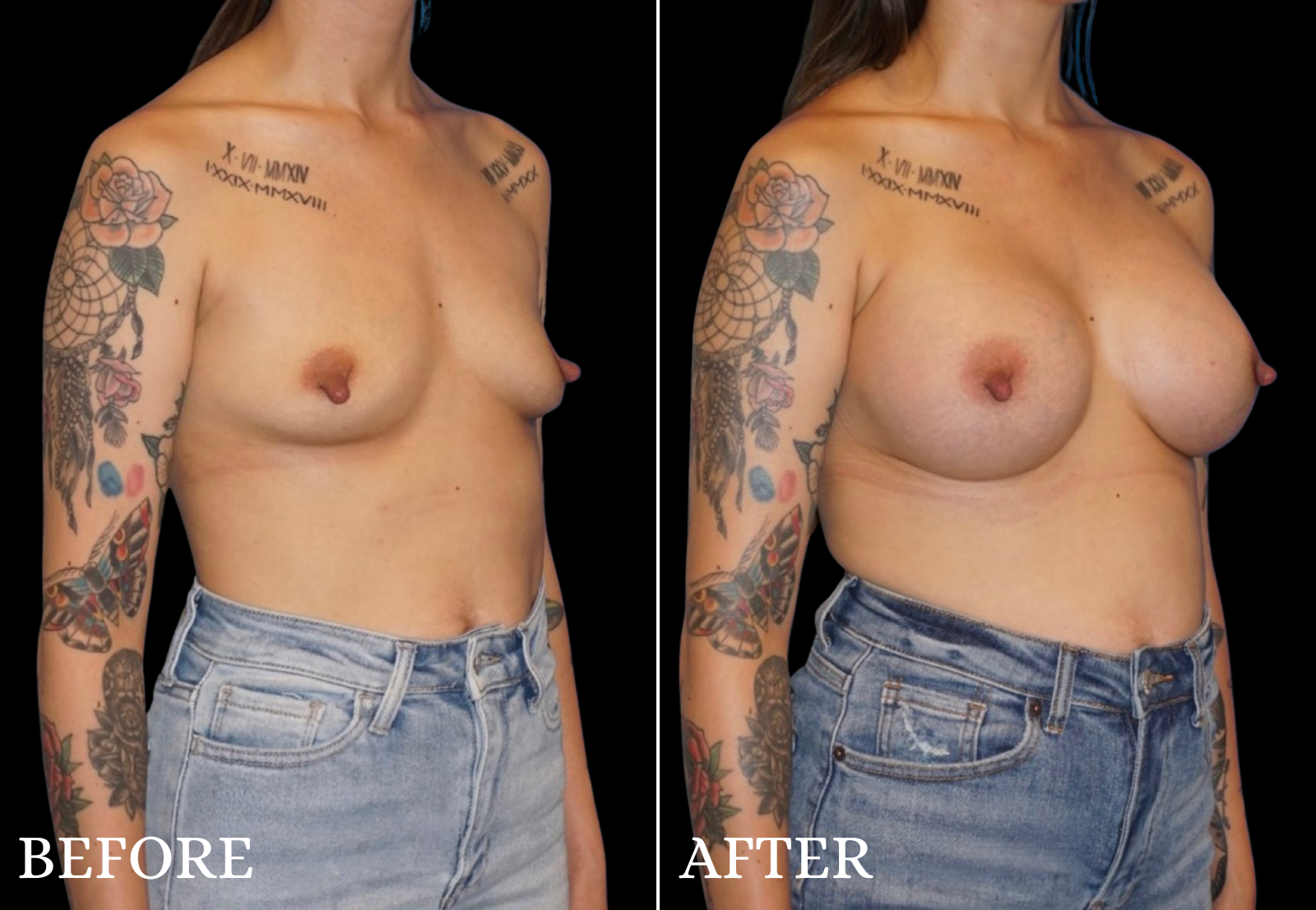 Breast Augmentation Before & After Gallery - Patient 376168 - Image 2