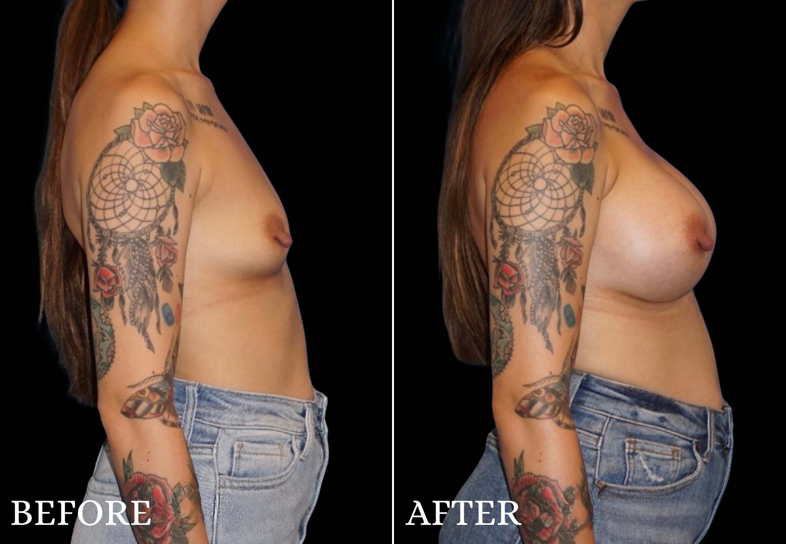 Breast Augmentation Before & After Gallery - Patient 376168 - Image 3