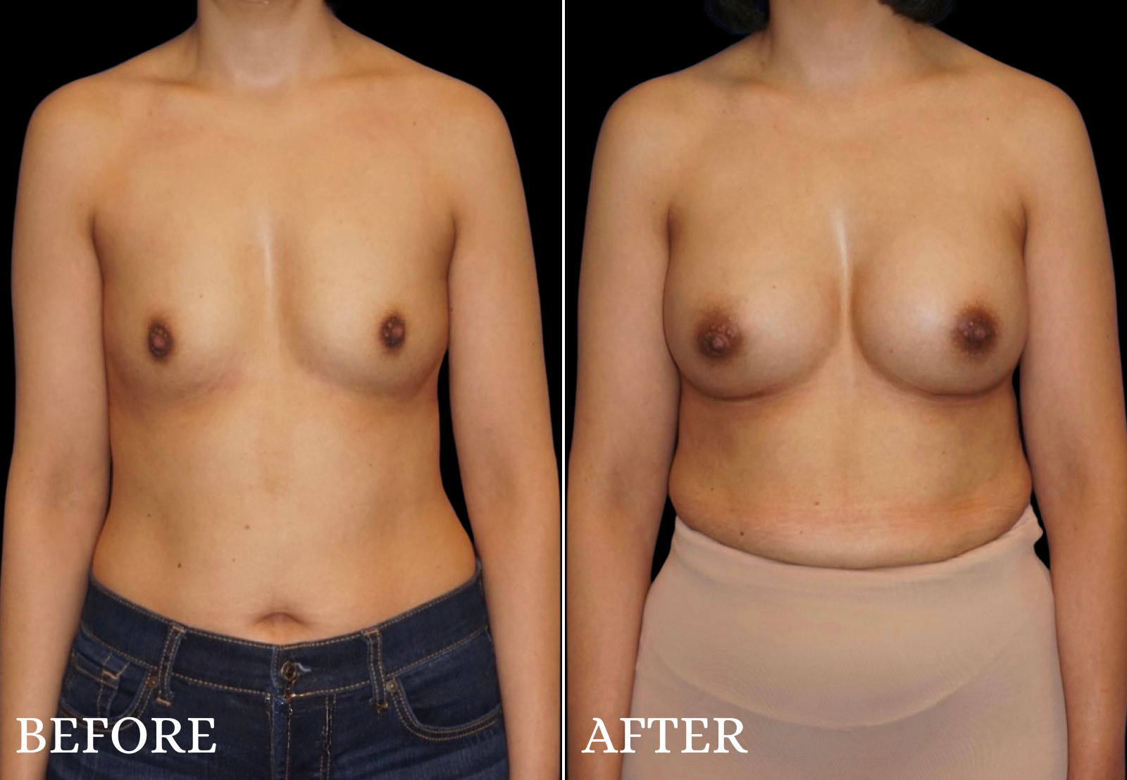 Breast Augmentation Before & After Gallery - Patient 205998 - Image 1