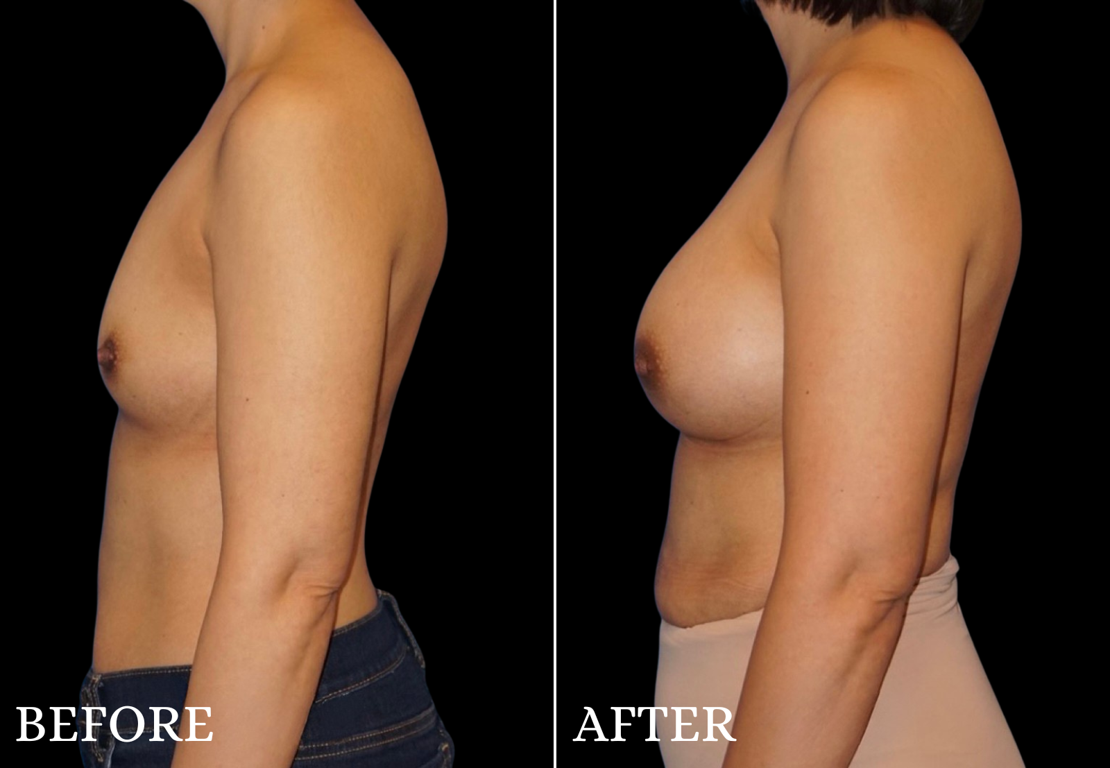 Breast Augmentation Before & After Gallery - Patient 205998 - Image 3