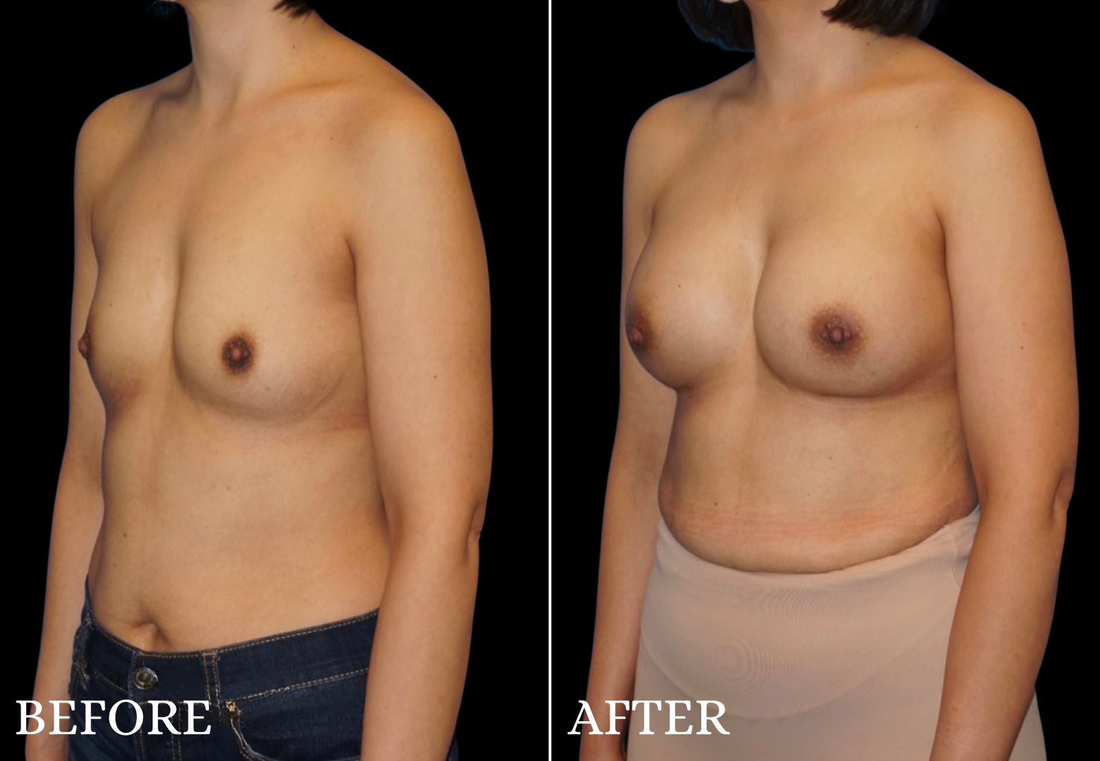 Breast Augmentation Before & After Gallery - Patient 205998 - Image 2