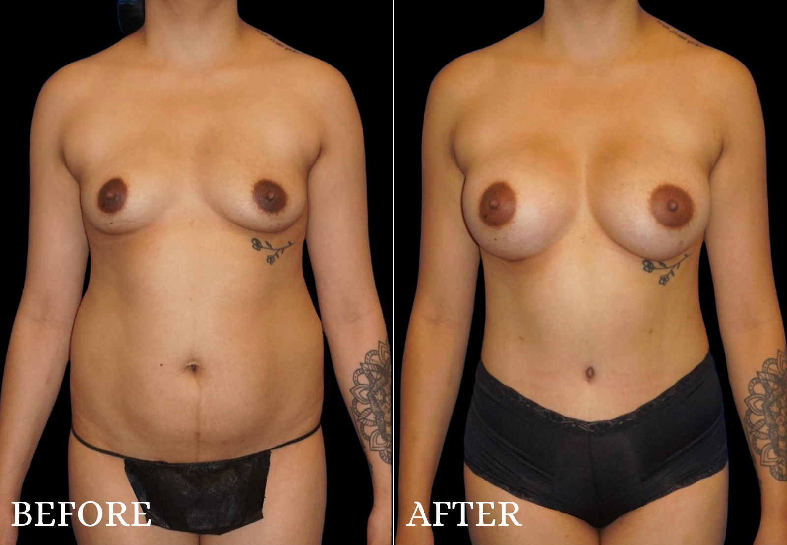 Breast Augmentation Before & After Gallery - Patient 303642 - Image 1