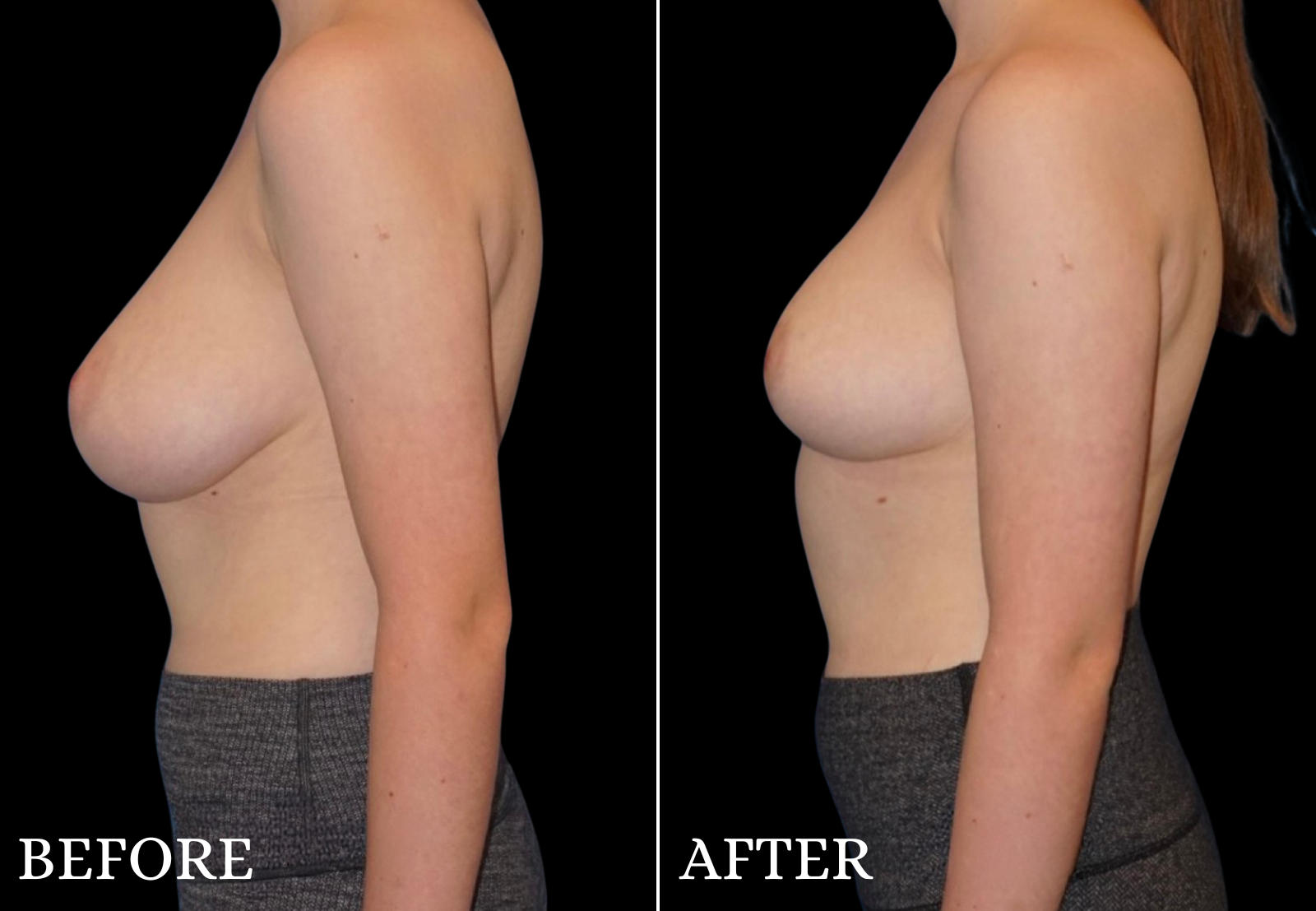 Breast Lift Before & After Gallery - Patient 192369 - Image 5