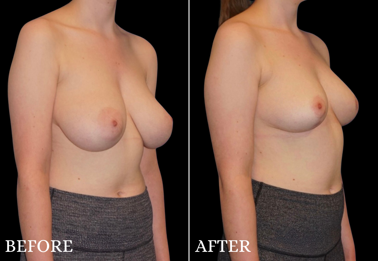 Breast Lift Before & After Gallery - Patient 192369 - Image 2