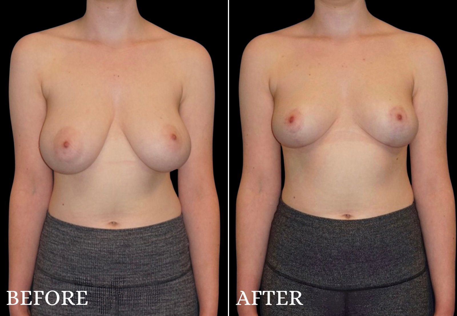 Breast Lift Before & After Gallery - Patient 192369 - Image 1