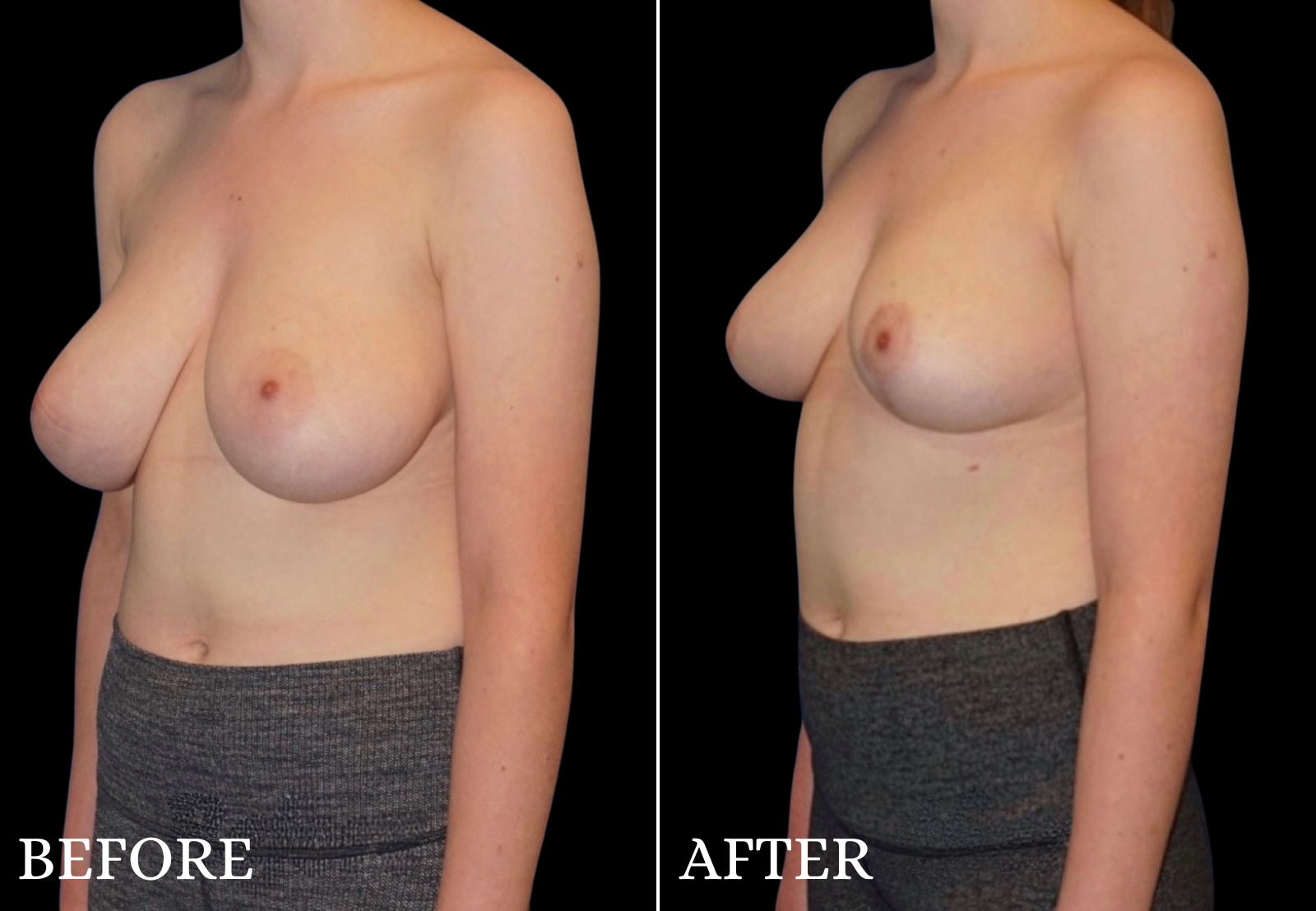 Breast Lift Before & After Gallery - Patient 192369 - Image 4