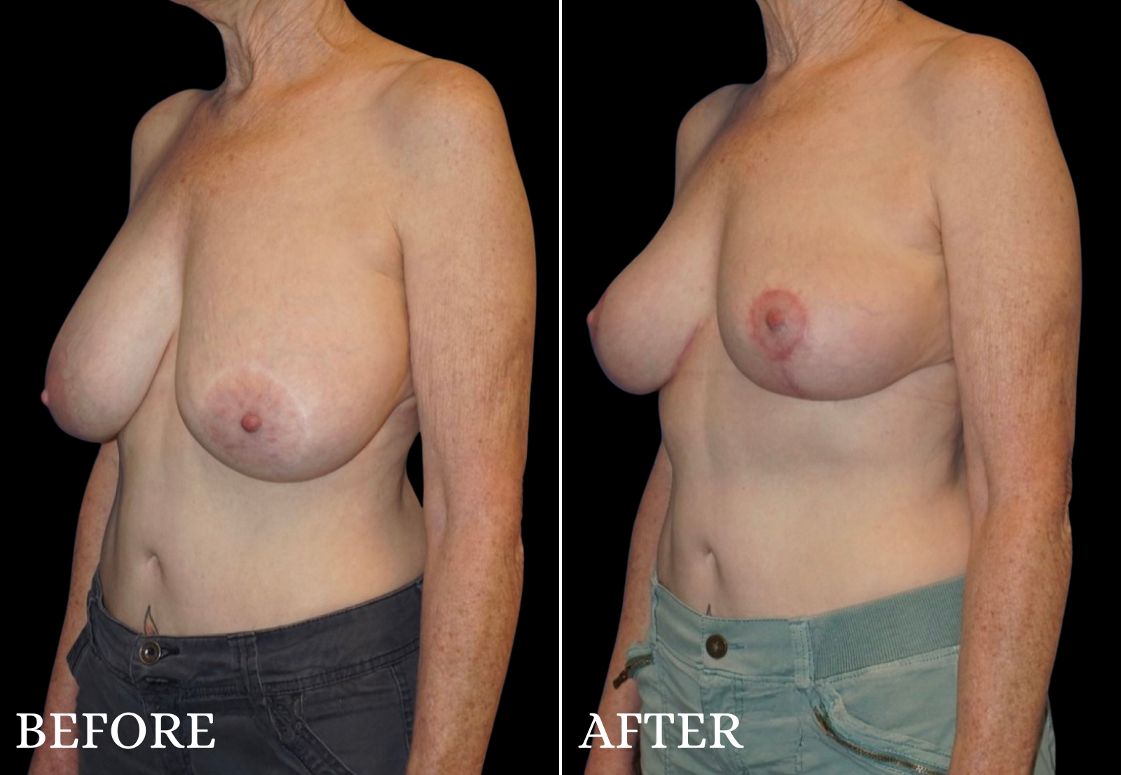 Breast Lift Before & After Gallery - Patient 673475 - Image 4