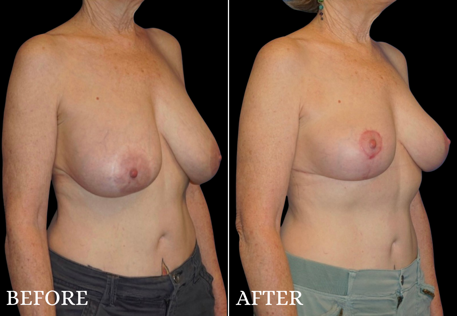 Breast Lift Before & After Gallery - Patient 673475 - Image 2