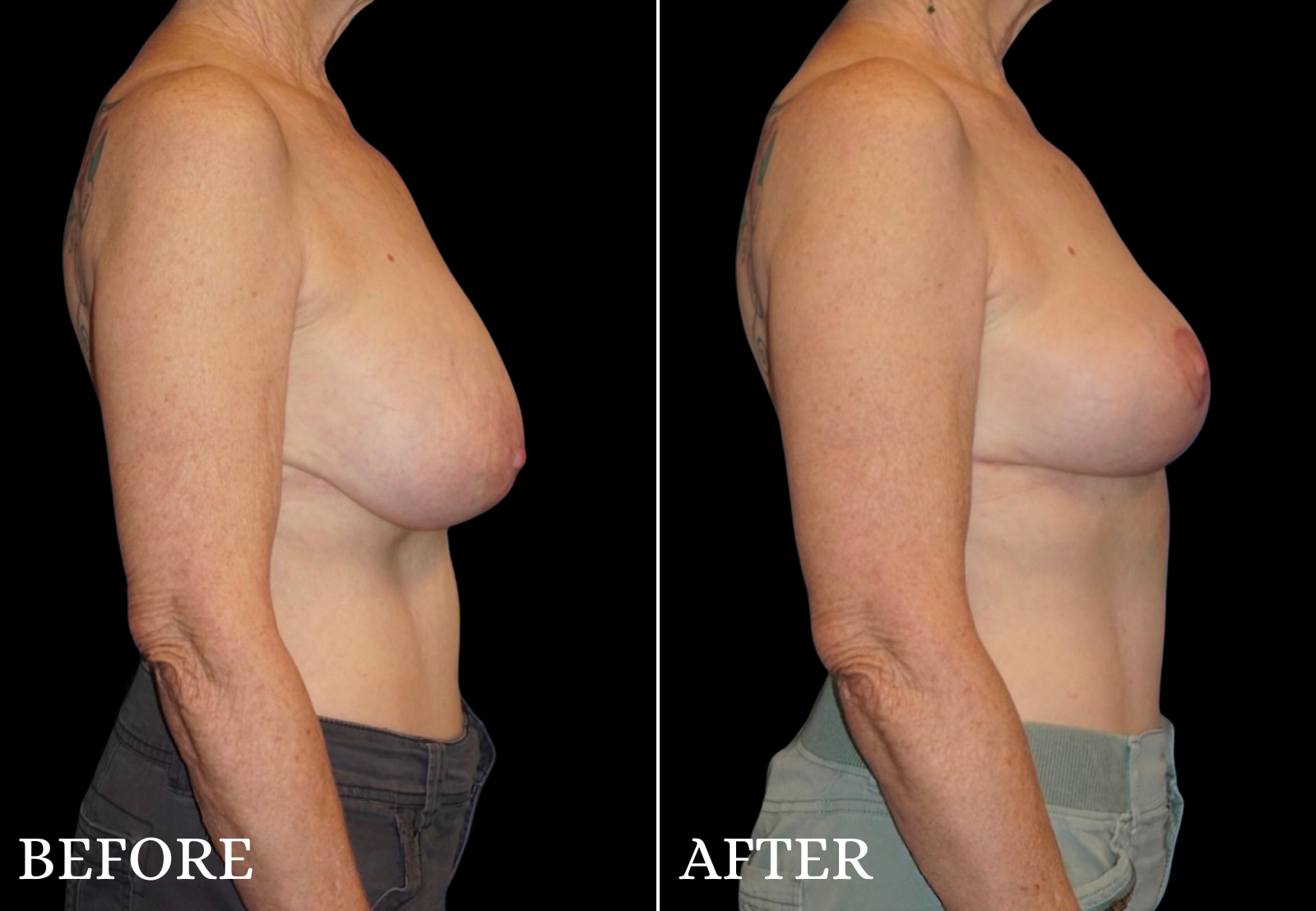 Breast Lift Before & After Gallery - Patient 673475 - Image 3