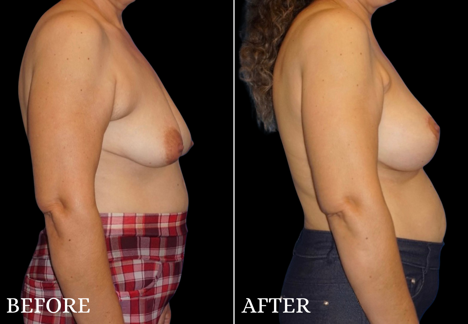 Breast Lift with Implant Before & After Gallery - Patient 921876 - Image 3