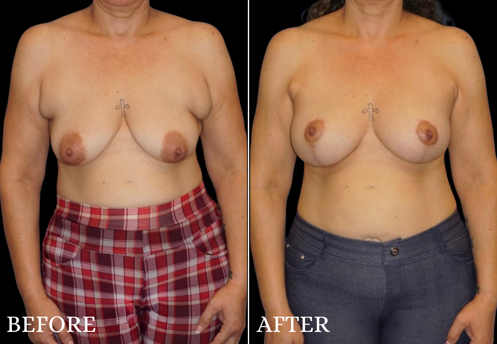 Breast Lift with Implant Before & After Gallery - Patient 921876 - Image 1
