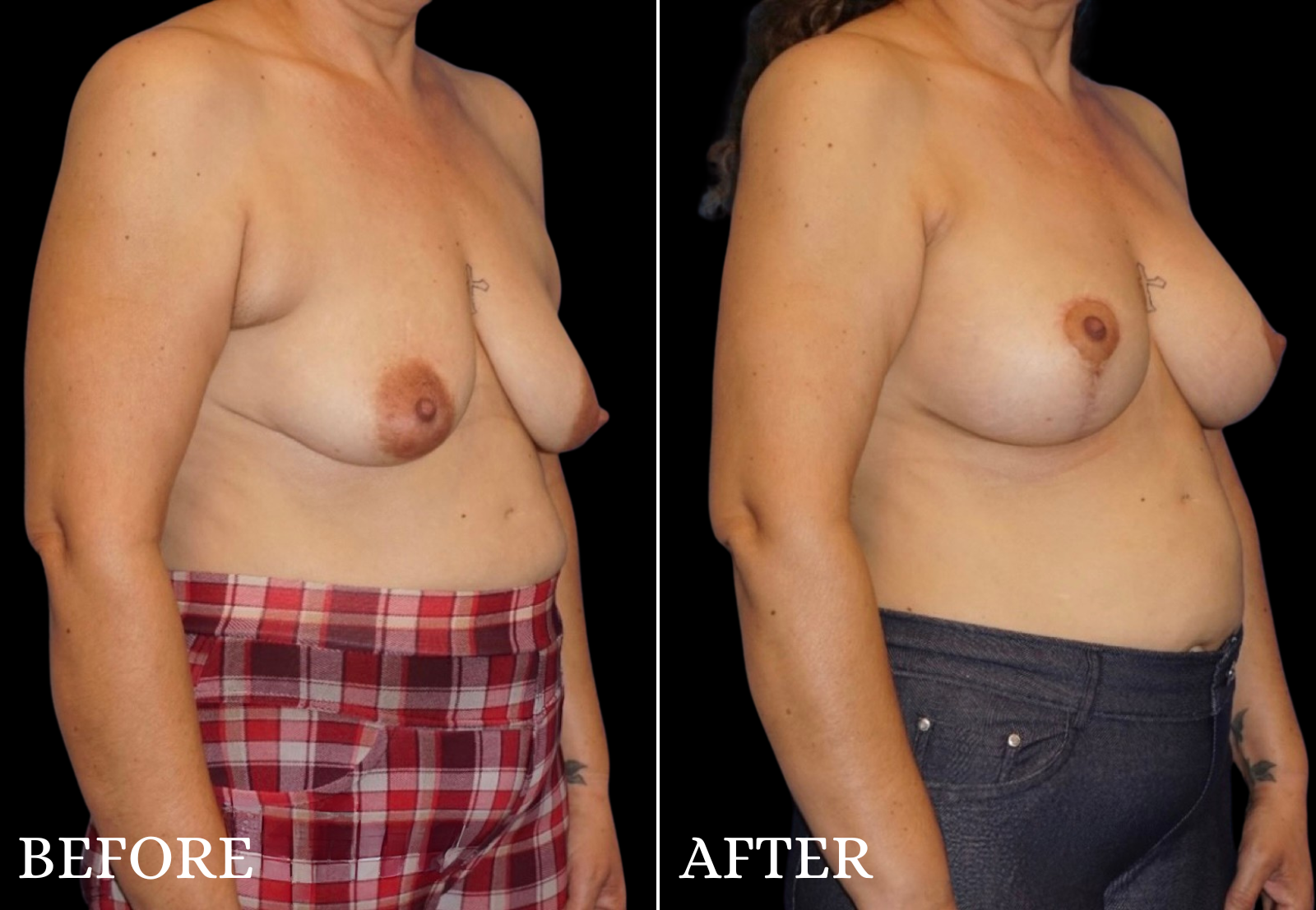 Breast Lift with Implant Before & After Gallery - Patient 921876 - Image 2