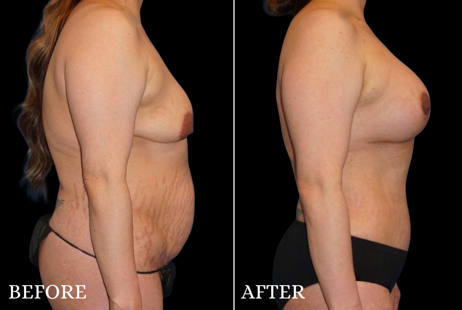 Tummy Tuck Before & After Gallery - Patient 319138 - Image 3