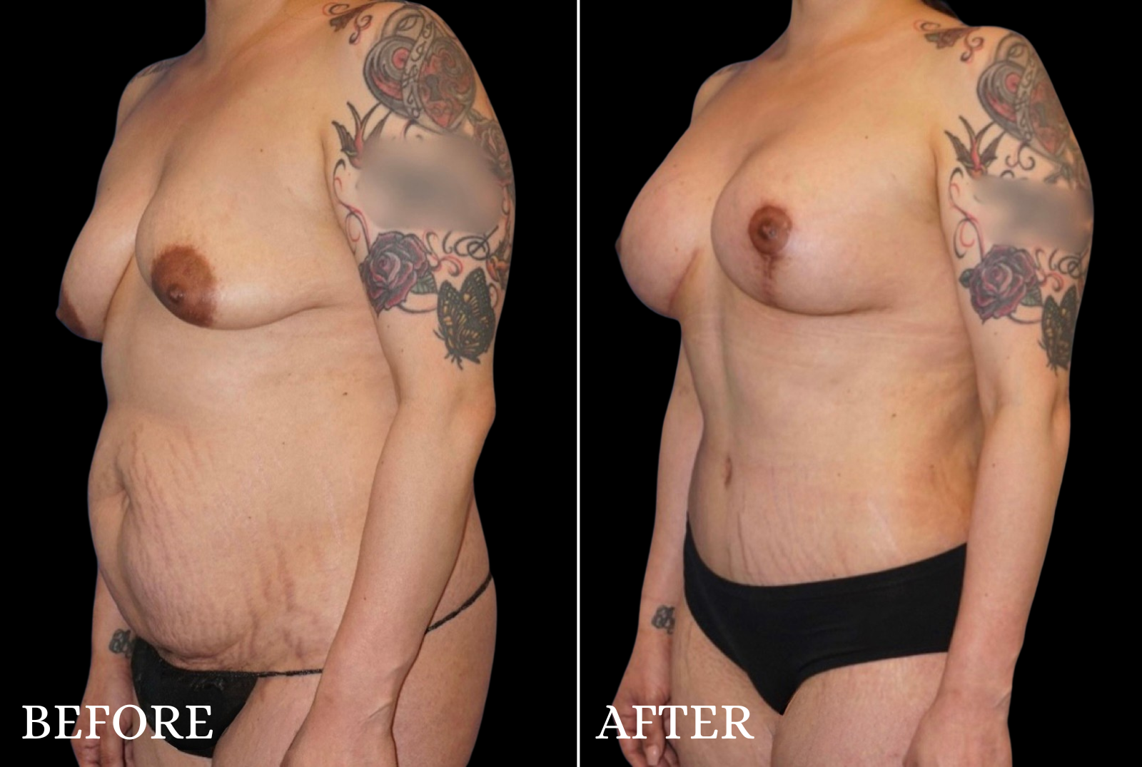 Tummy Tuck Before & After Gallery - Patient 319138 - Image 4