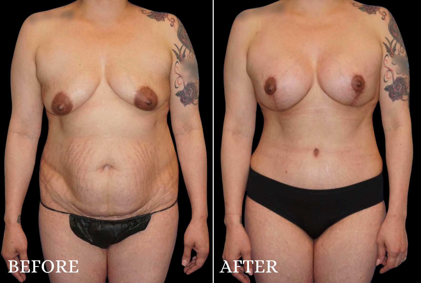 Tummy Tuck Before & After Gallery - Patient 319138 - Image 1