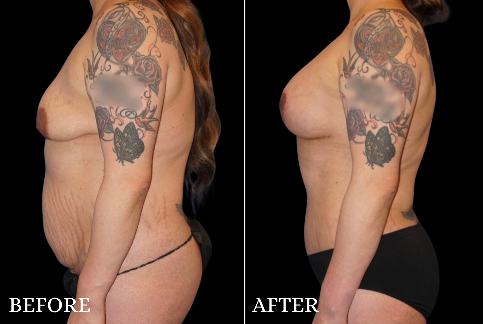 Tummy Tuck Before & After Gallery - Patient 319138 - Image 5