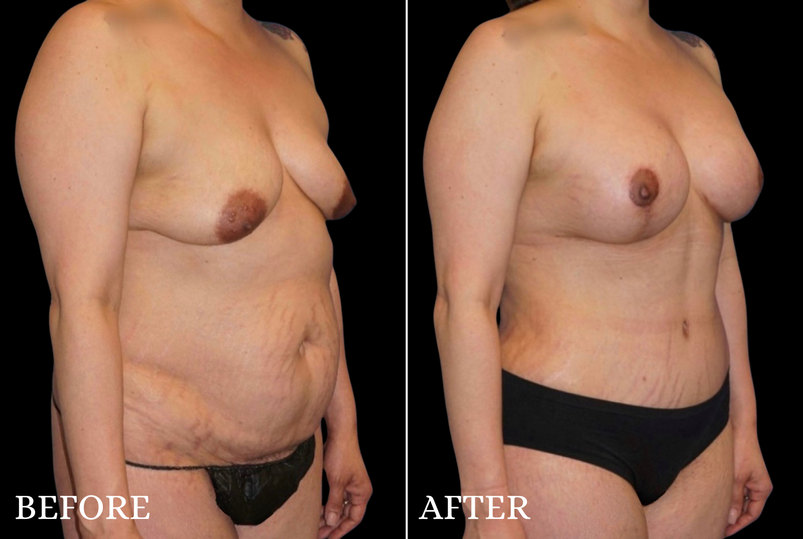 Tummy Tuck Before & After Gallery - Patient 319138 - Image 2
