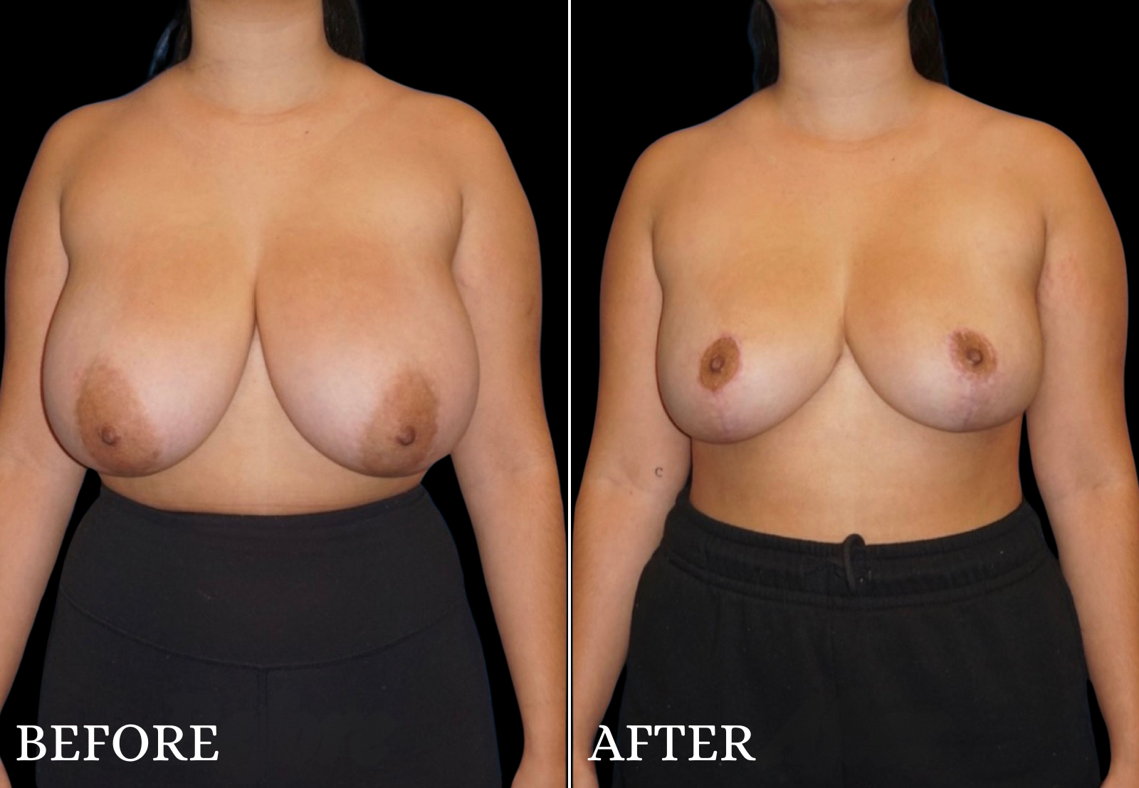 Breast Reduction Before & After Gallery - Patient 974923 - Image 1