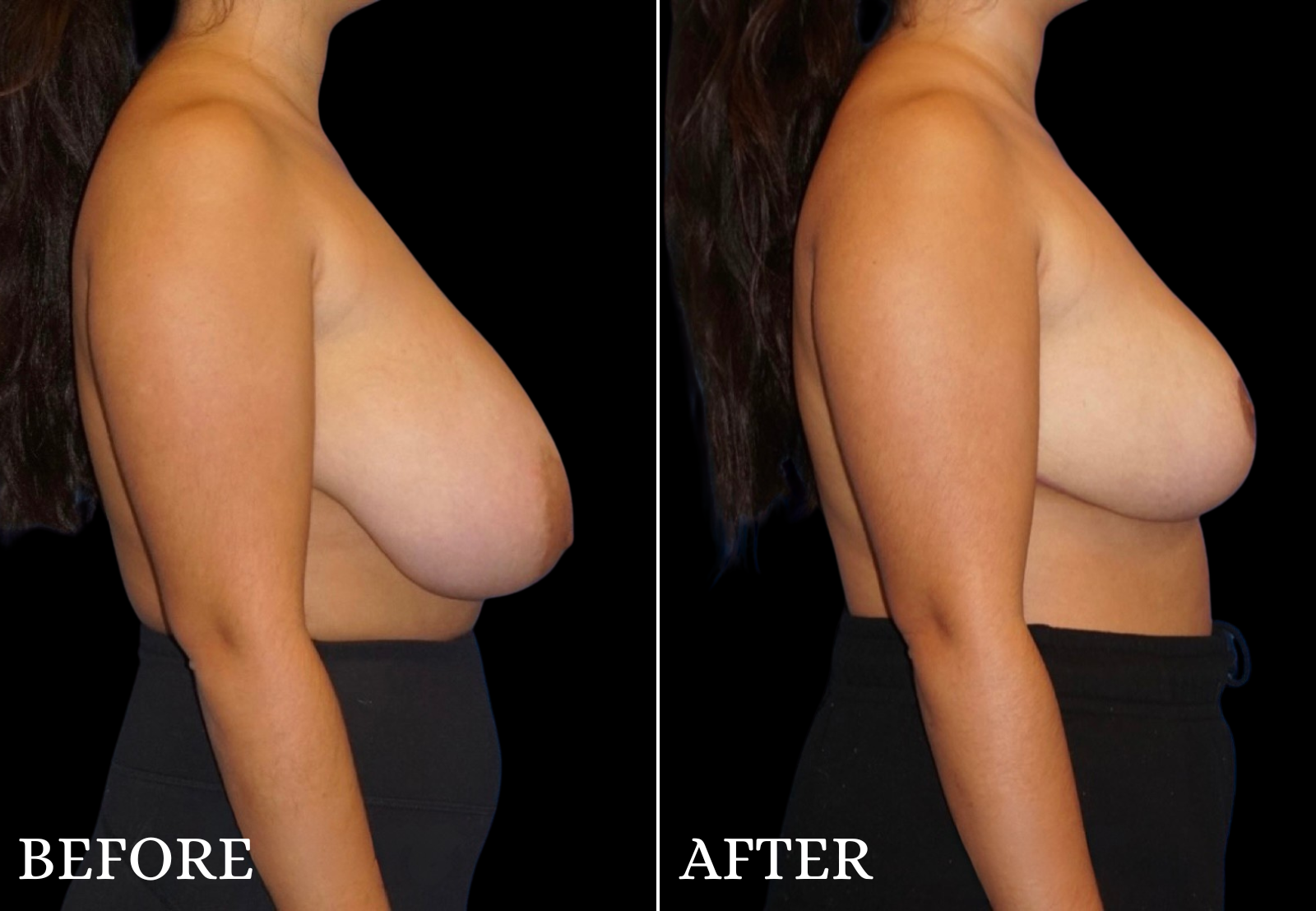 Breast Reduction Before & After Gallery - Patient 974923 - Image 2
