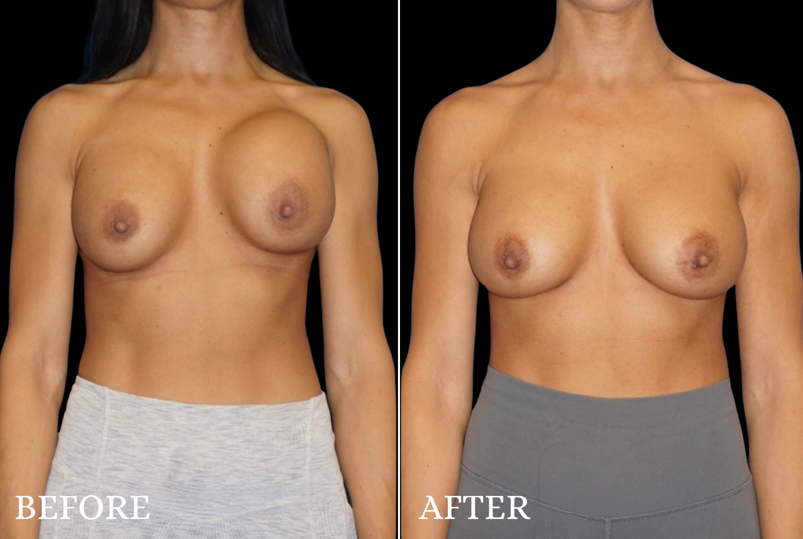 Breast Implant Revision Before & After Gallery - Patient 240165 - Image 1