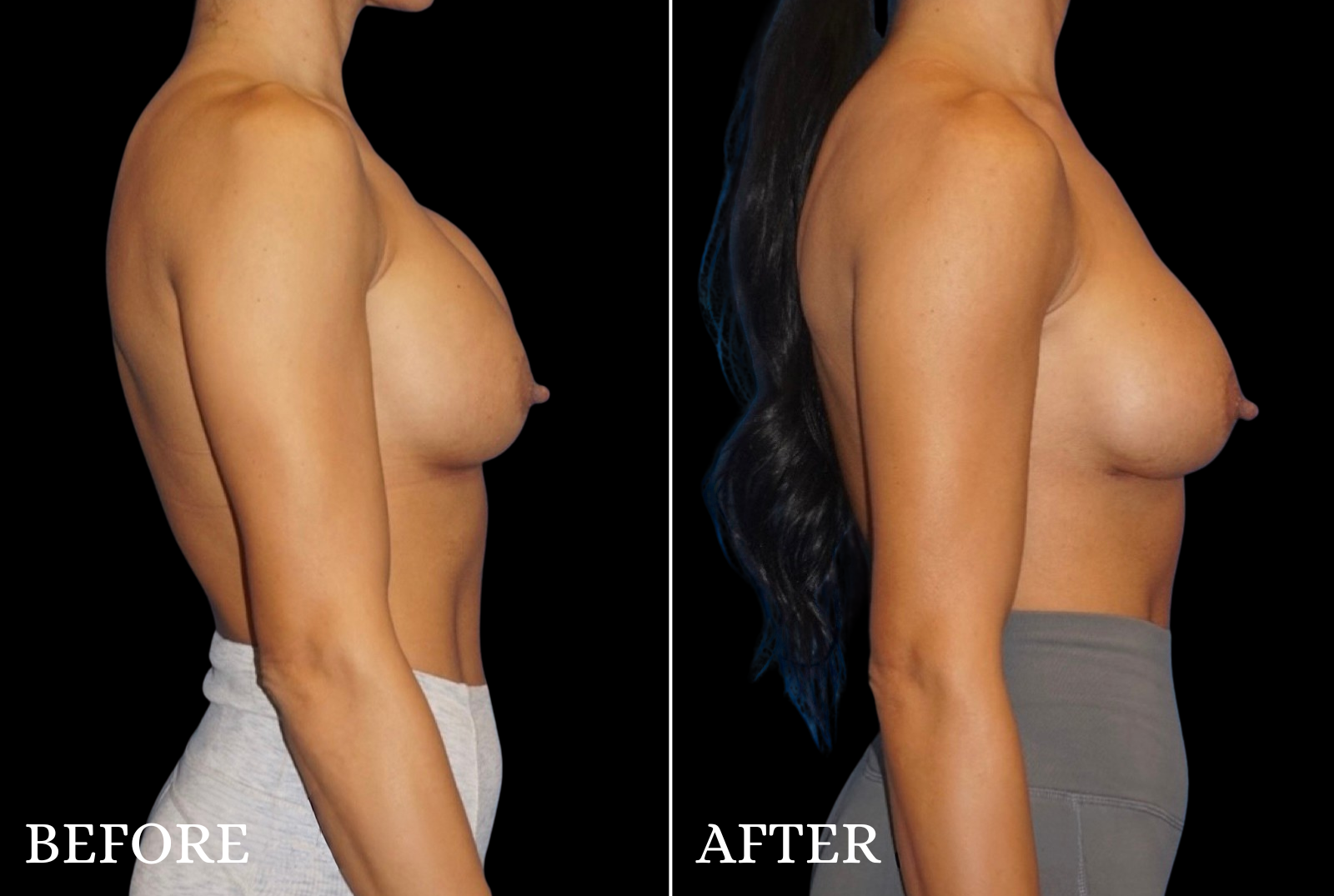 Breast Implant Revision Before & After Gallery - Patient 240165 - Image 3