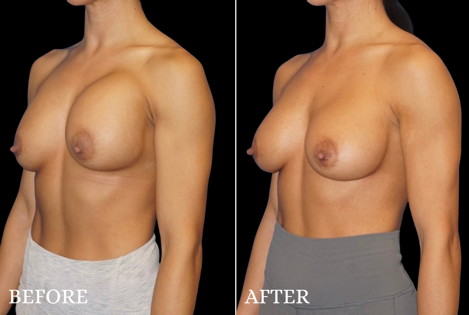 Breast Implant Revision Before & After Gallery - Patient 240165 - Image 4