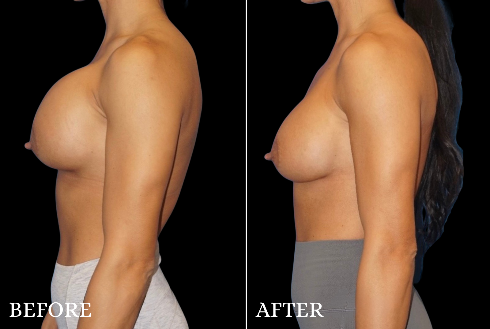 Breast Implant Revision Before & After Gallery - Patient 240165 - Image 5