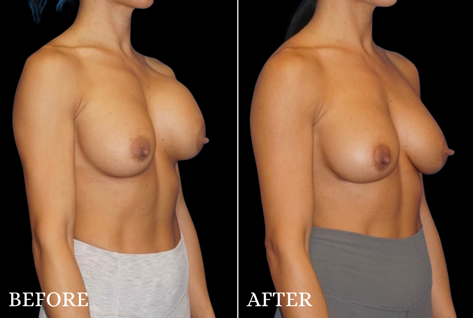 Breast Implant Revision Before & After Gallery - Patient 240165 - Image 2