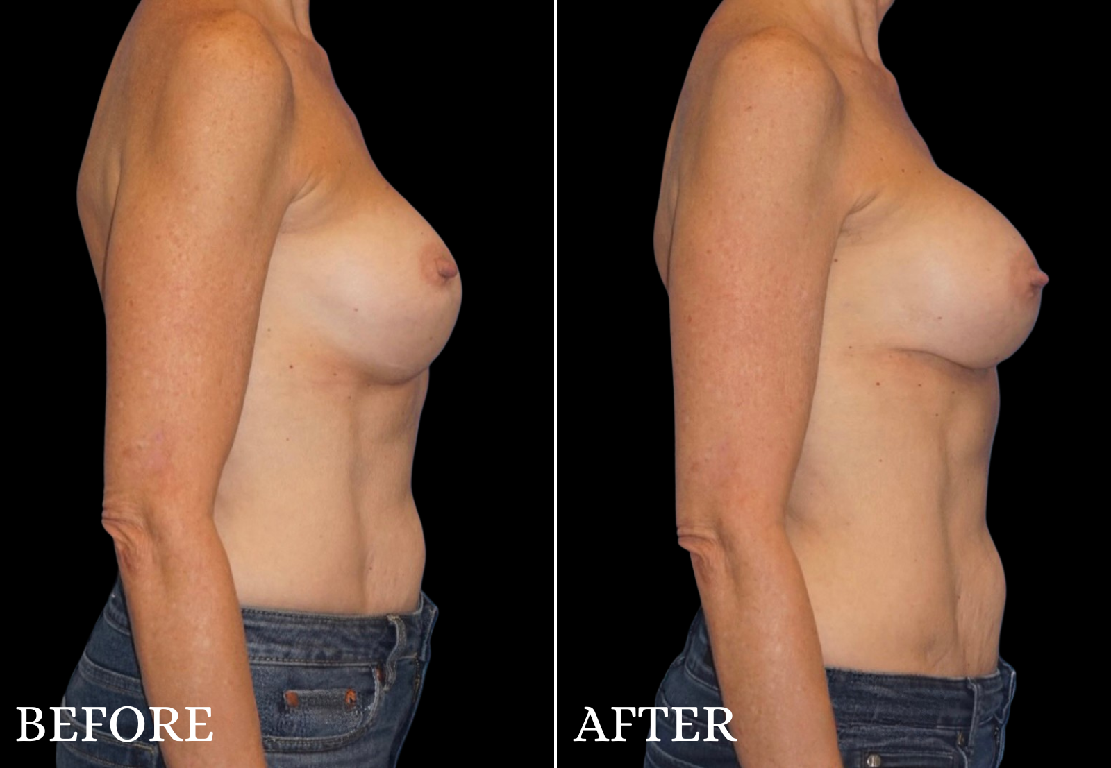 Breast Implant Revision Before & After Gallery - Patient 403101 - Image 3