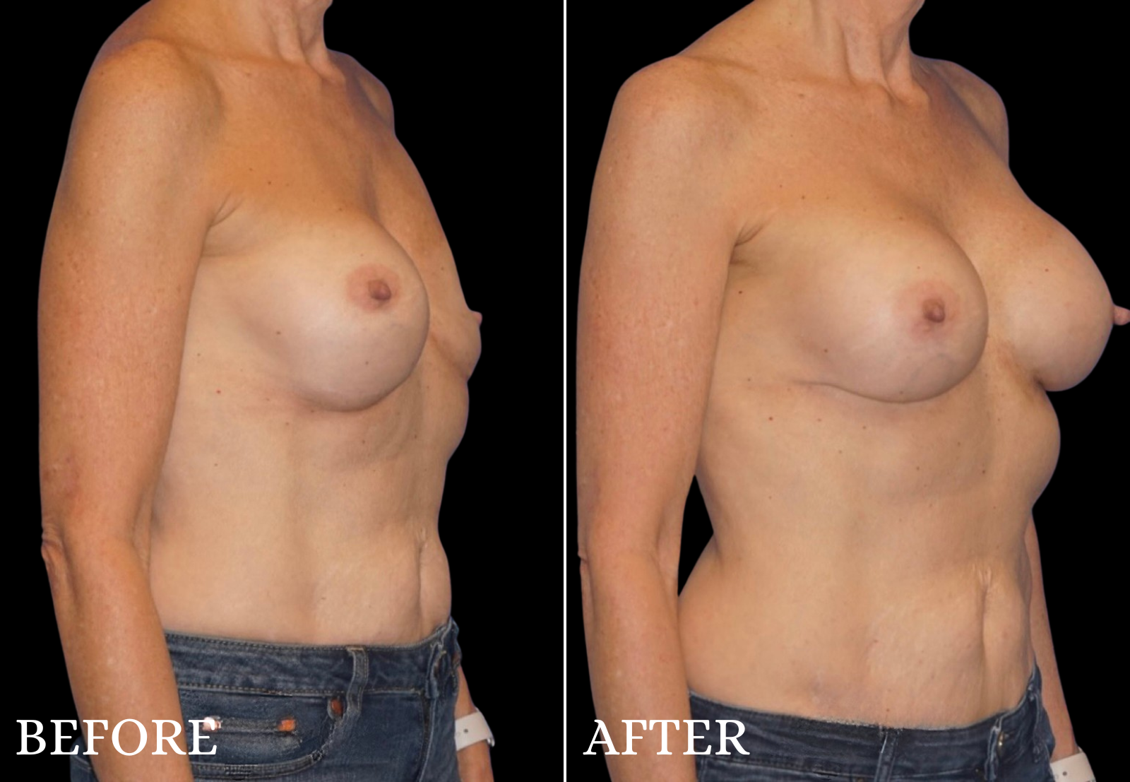 Breast Implant Revision Before & After Gallery - Patient 403101 - Image 2