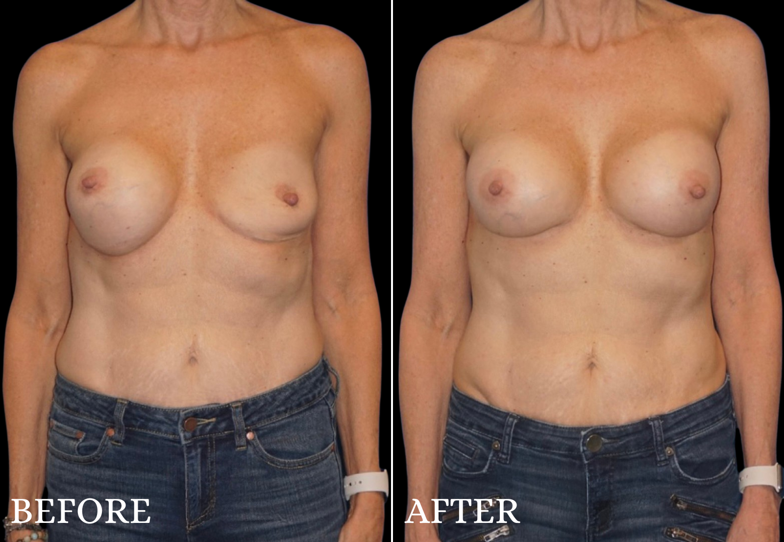 Breast Implant Revision Before & After Gallery - Patient 403101 - Image 1