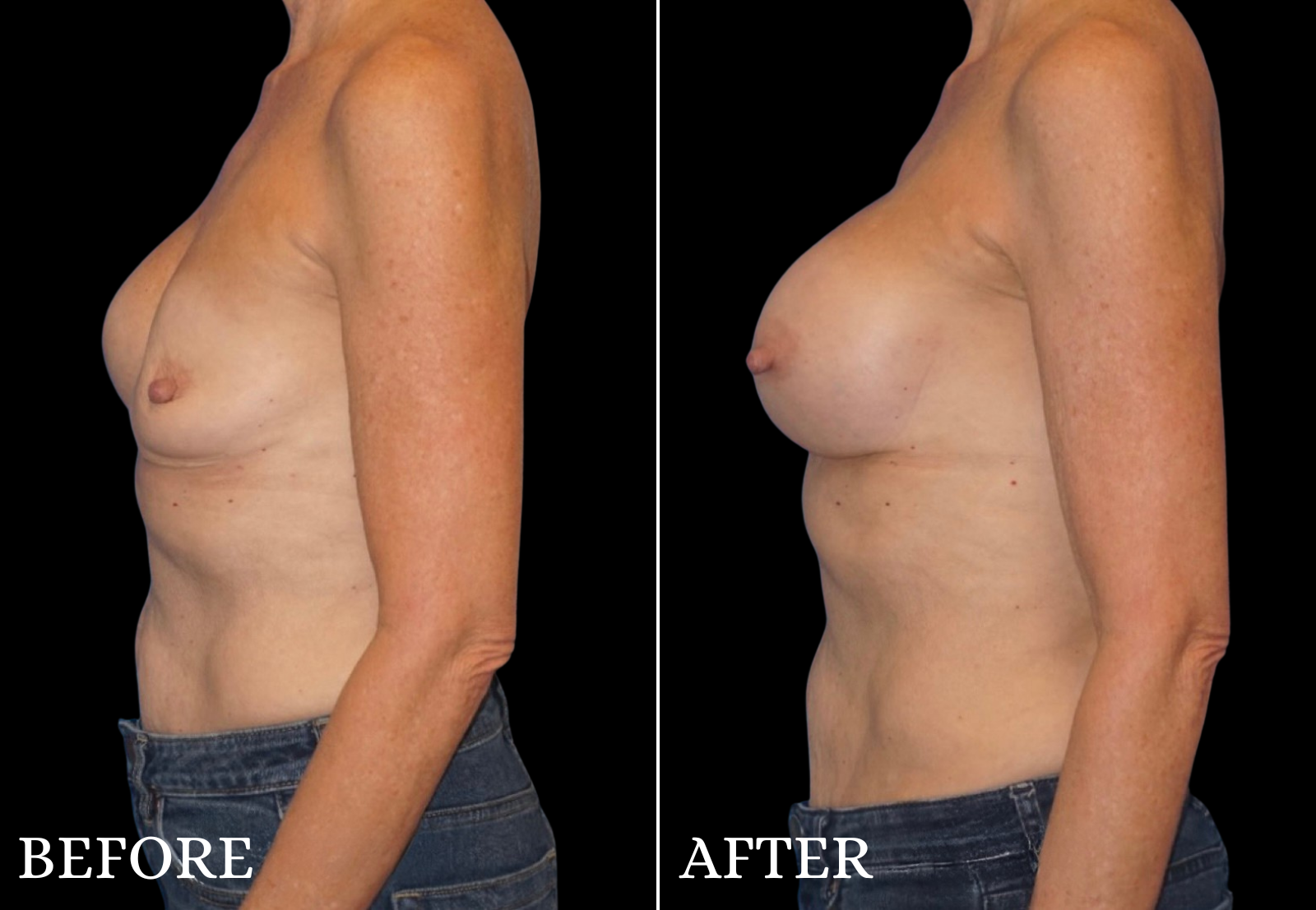 Breast Implant Revision Before & After Gallery - Patient 403101 - Image 5