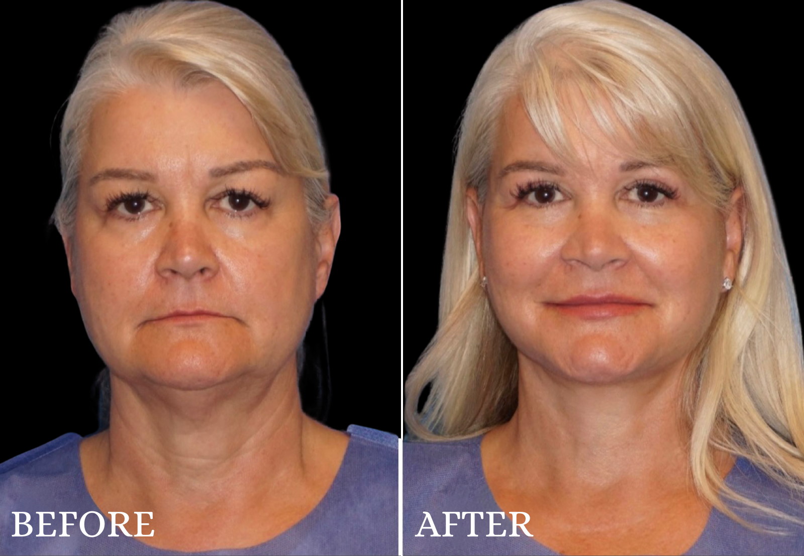 Upper Blepharoplasty Before & After Gallery - Patient 306759 - Image 1