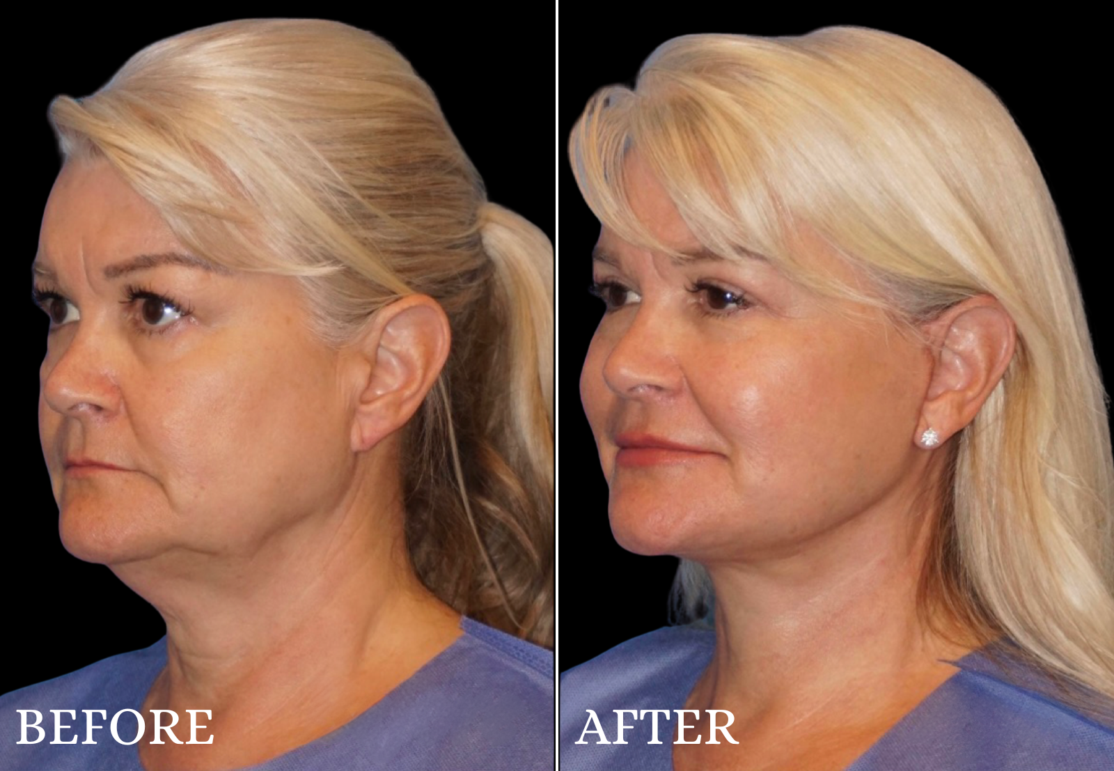 Upper Blepharoplasty Before & After Gallery - Patient 306759 - Image 4