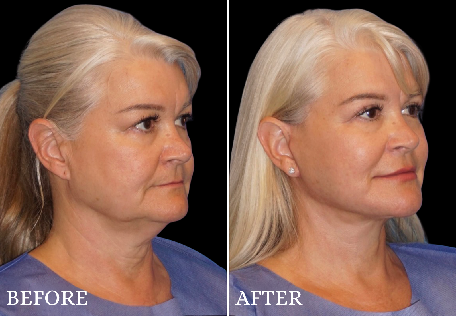 Upper Blepharoplasty Before & After Gallery - Patient 306759 - Image 2