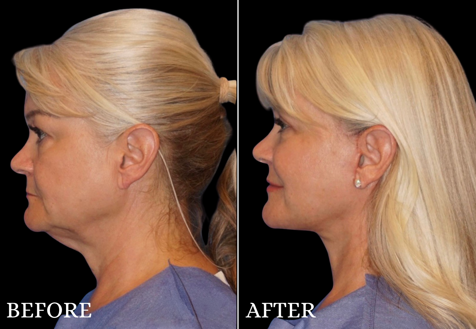 Upper Blepharoplasty Before & After Gallery - Patient 306759 - Image 5
