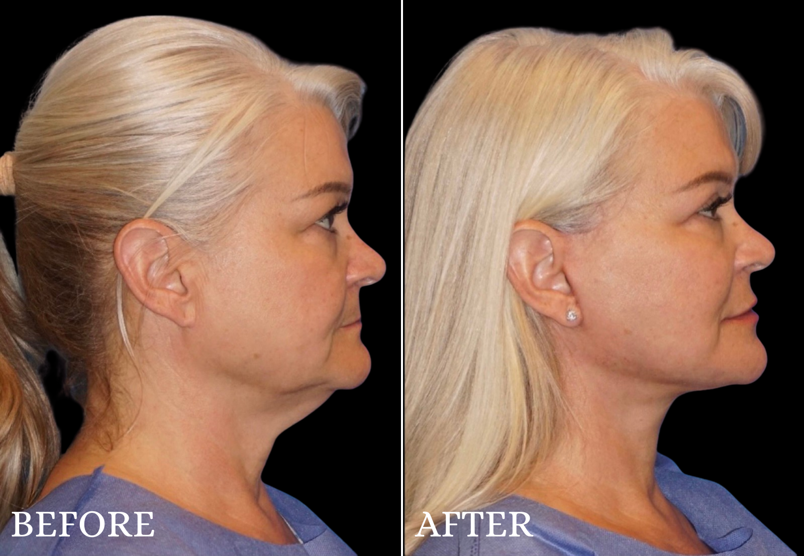 Neck Lift Before & After Gallery - Patient 389256 - Image 1