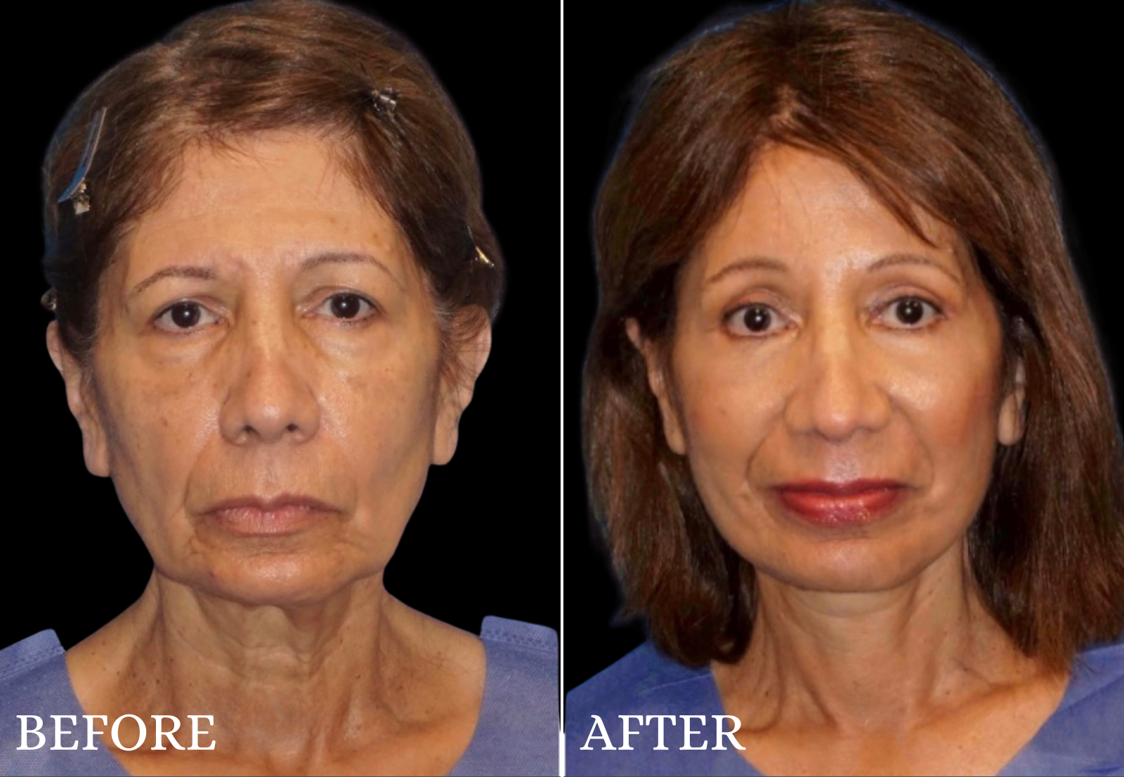 Facelift Before & After Gallery - Patient 364998 - Image 1