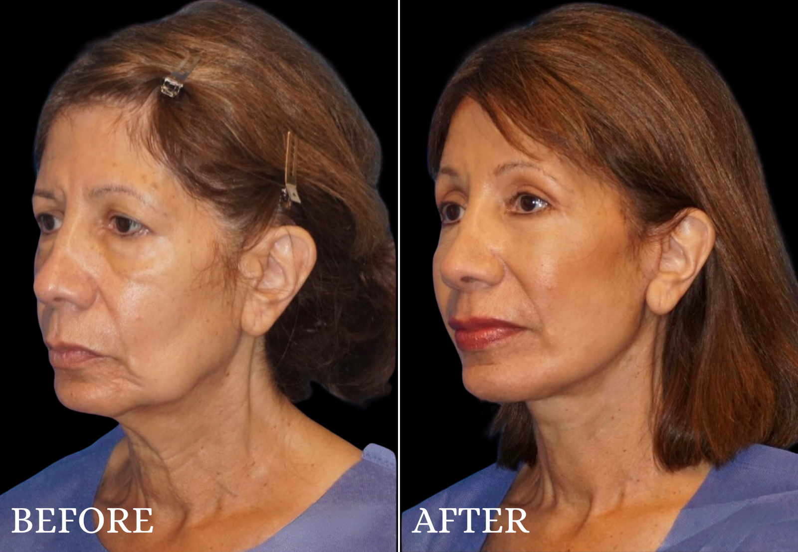Facelift Before & After Gallery - Patient 364998 - Image 4