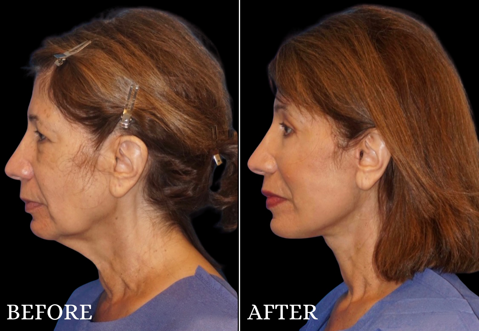 Facelift Before & After Gallery - Patient 364998 - Image 5