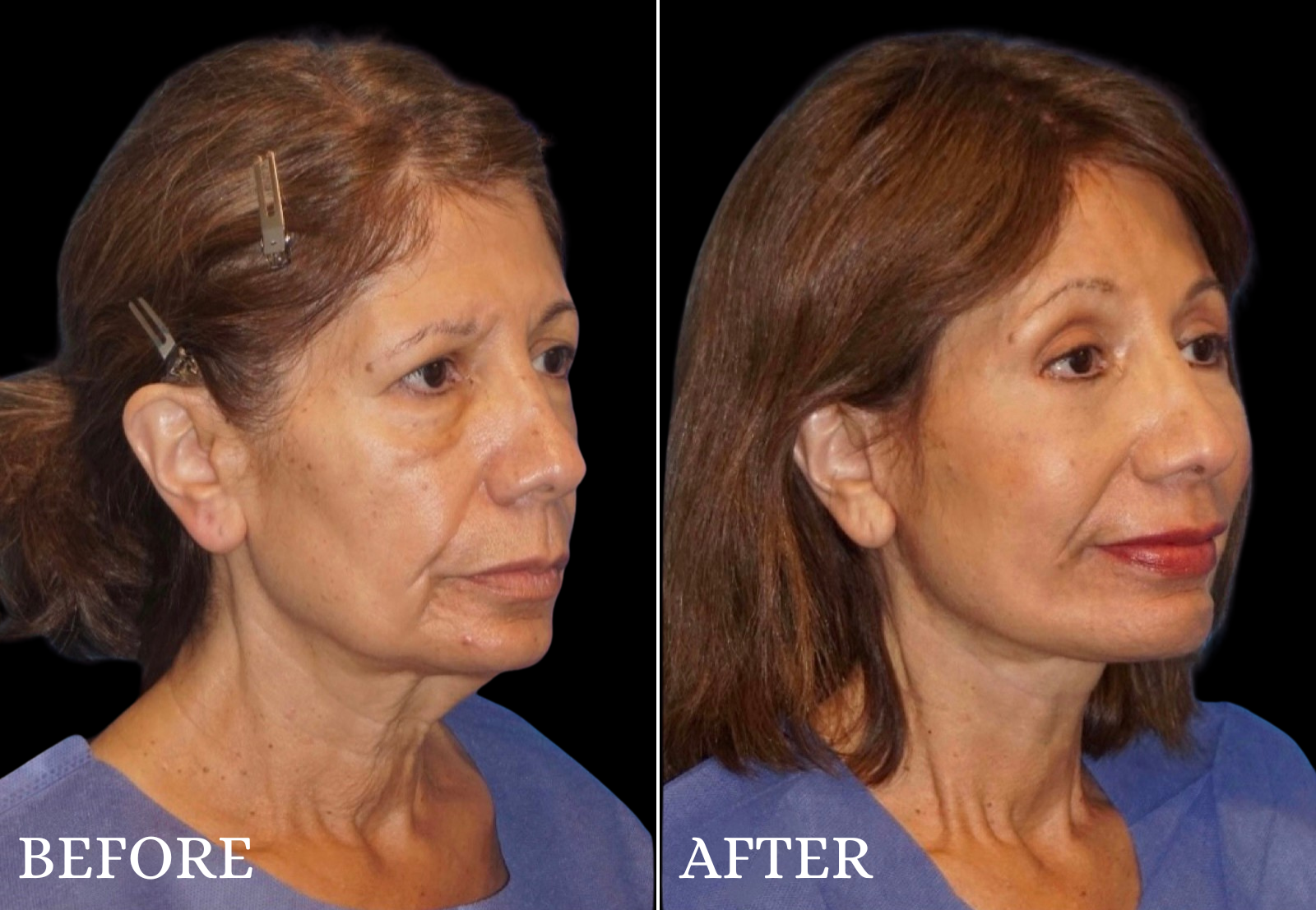Facelift Before & After Gallery - Patient 364998 - Image 2