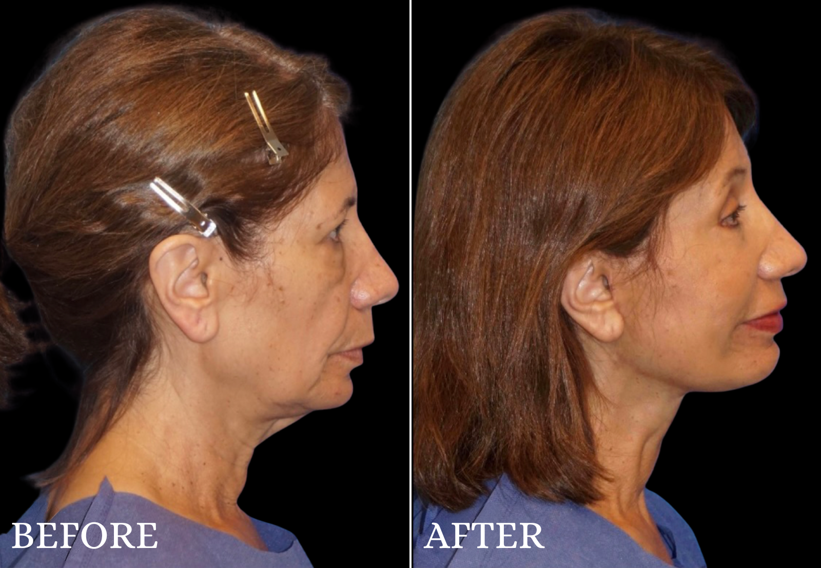 Facelift Before & After Gallery - Patient 364998 - Image 3