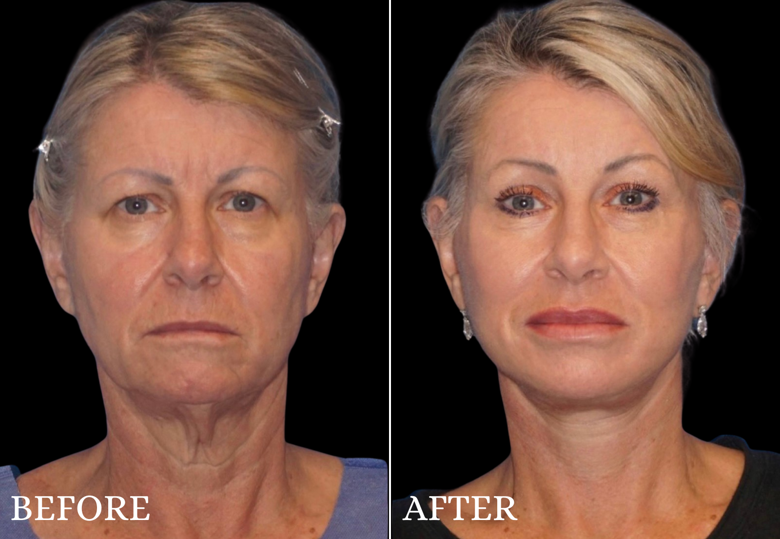 Neck Lift Before & After Gallery - Patient 411016 - Image 1