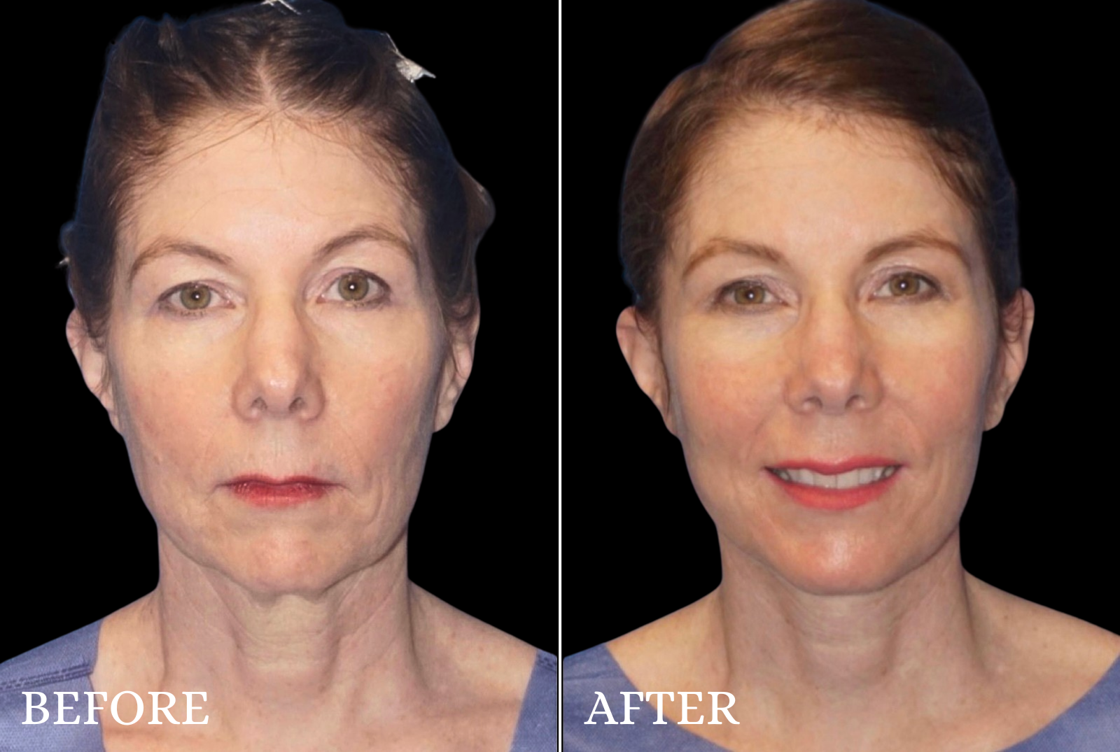 Facelift Before & After Gallery - Patient 209384 - Image 1
