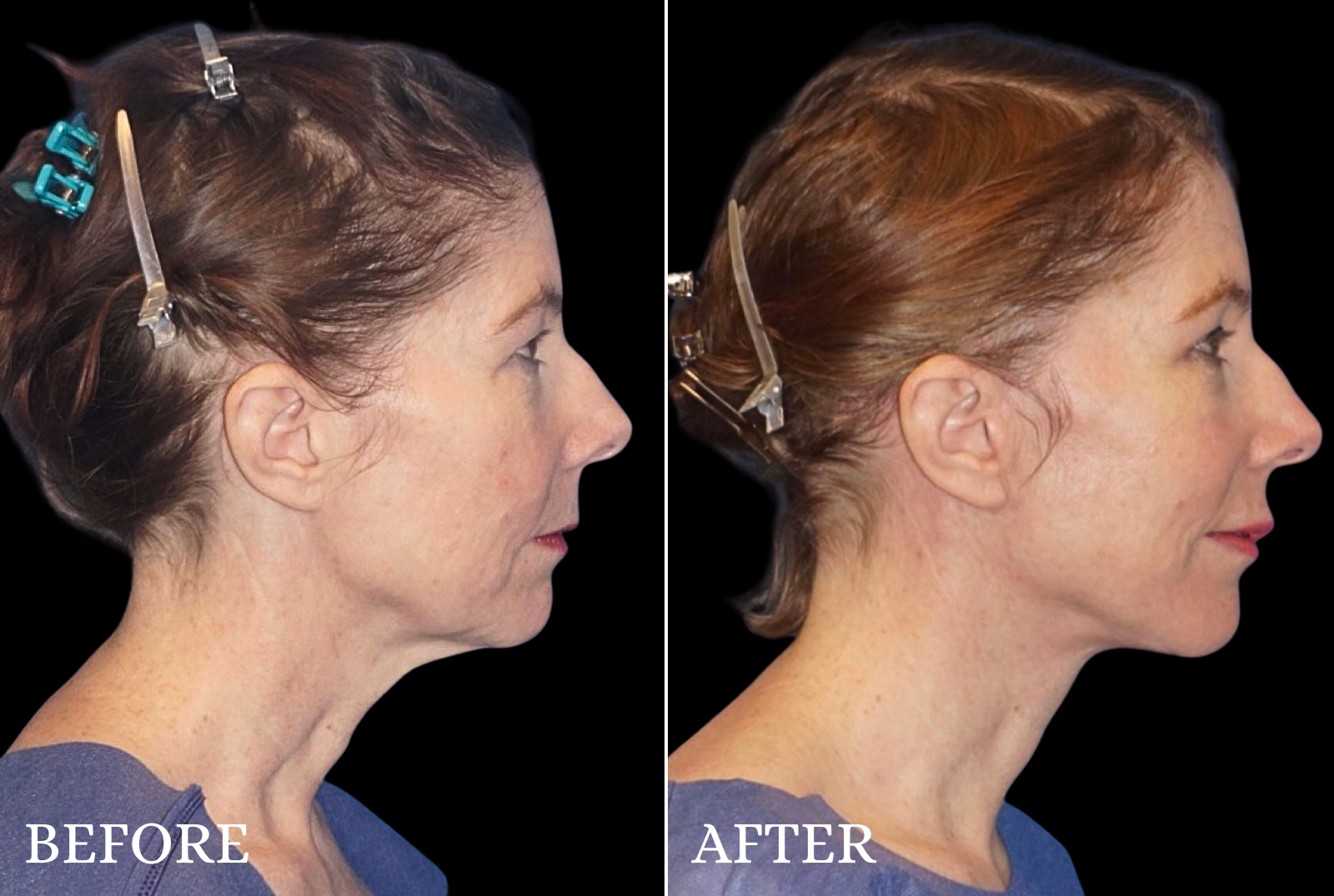 Facelift Before & After Gallery - Patient 209384 - Image 3