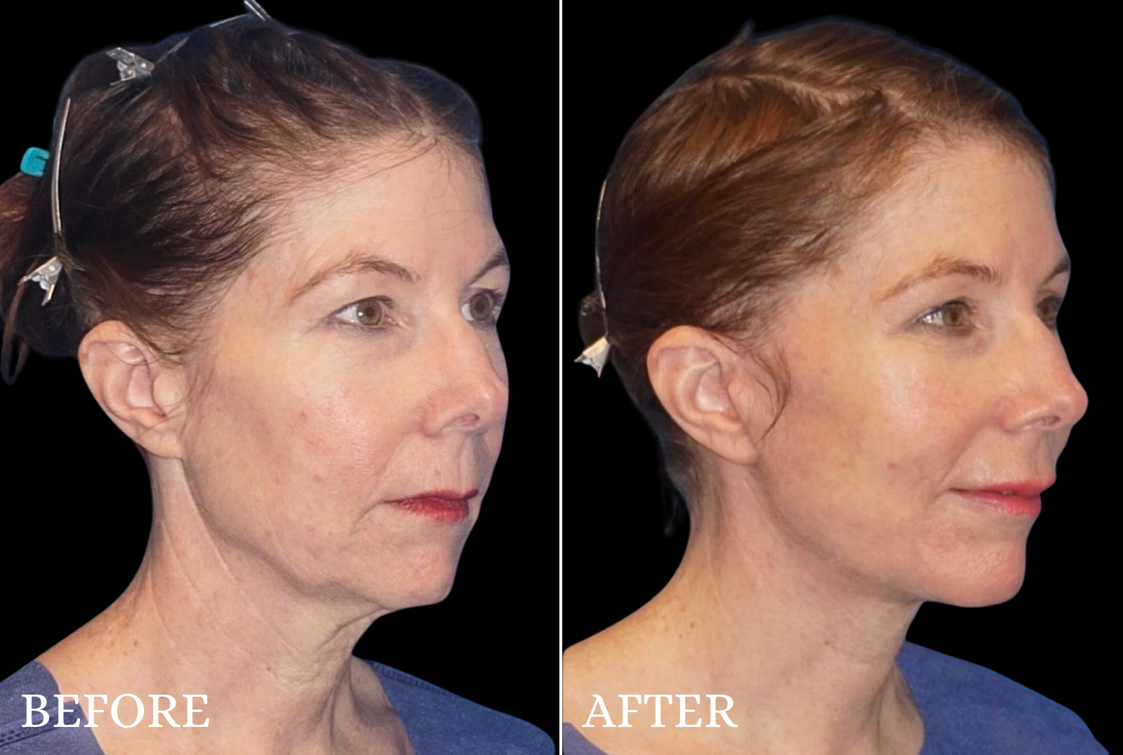 Facelift Before & After Gallery - Patient 209384 - Image 2