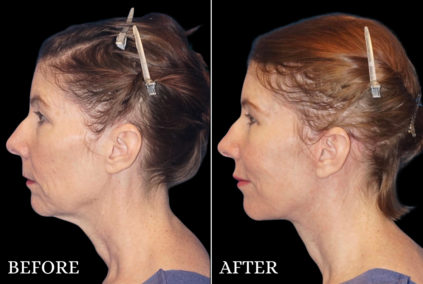 Neck Lift Before & After Gallery - Patient 290000 - Image 1
