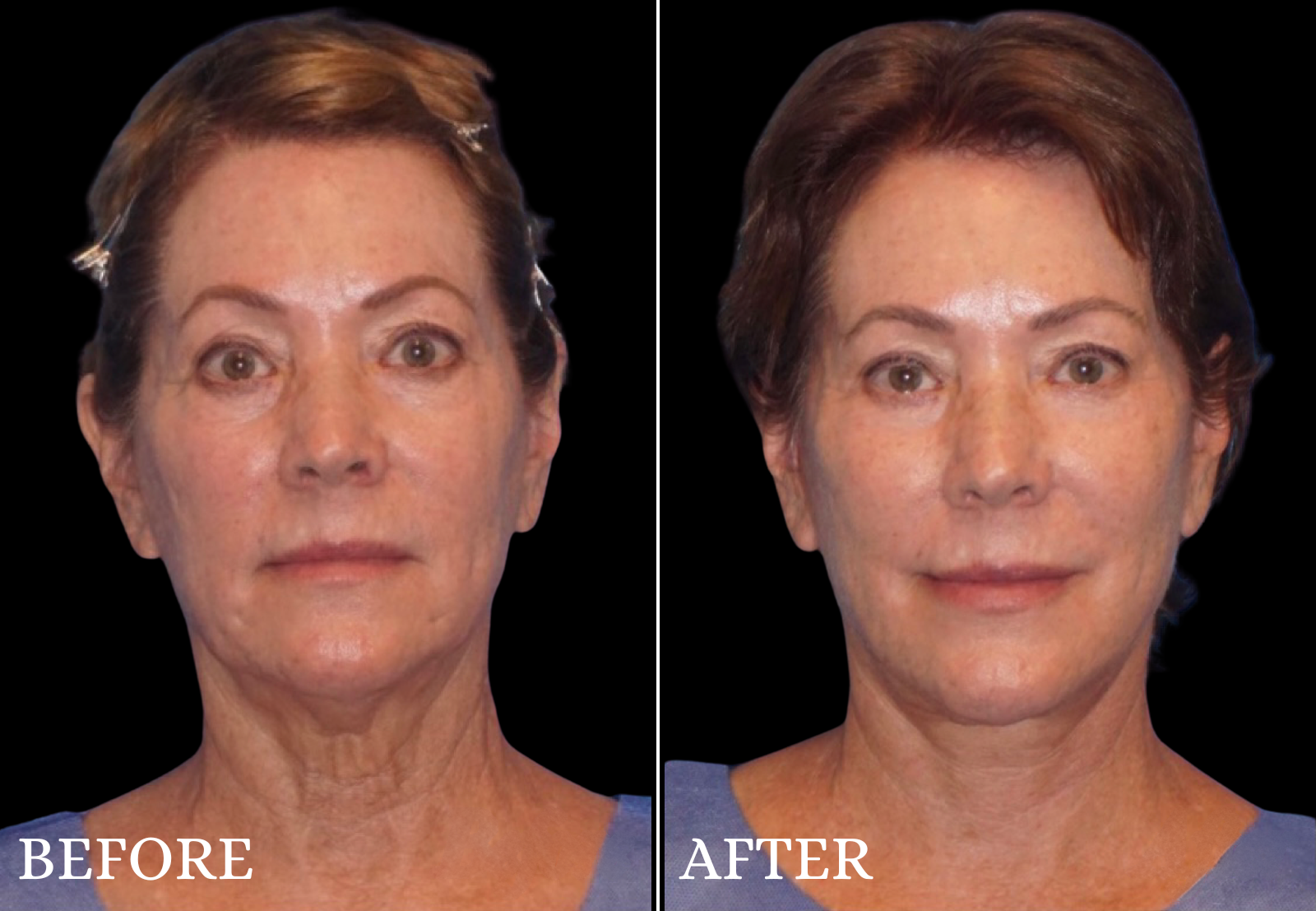 Neck Lift Before & After Gallery - Patient 299414 - Image 3