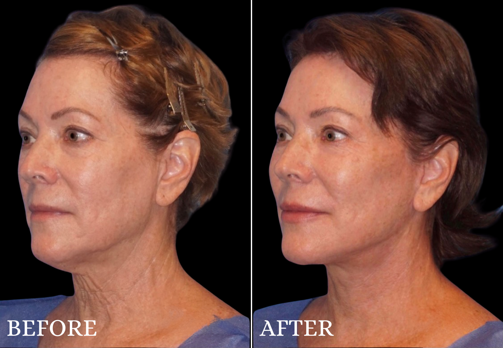 Neck Lift Before & After Gallery - Patient 299414 - Image 2