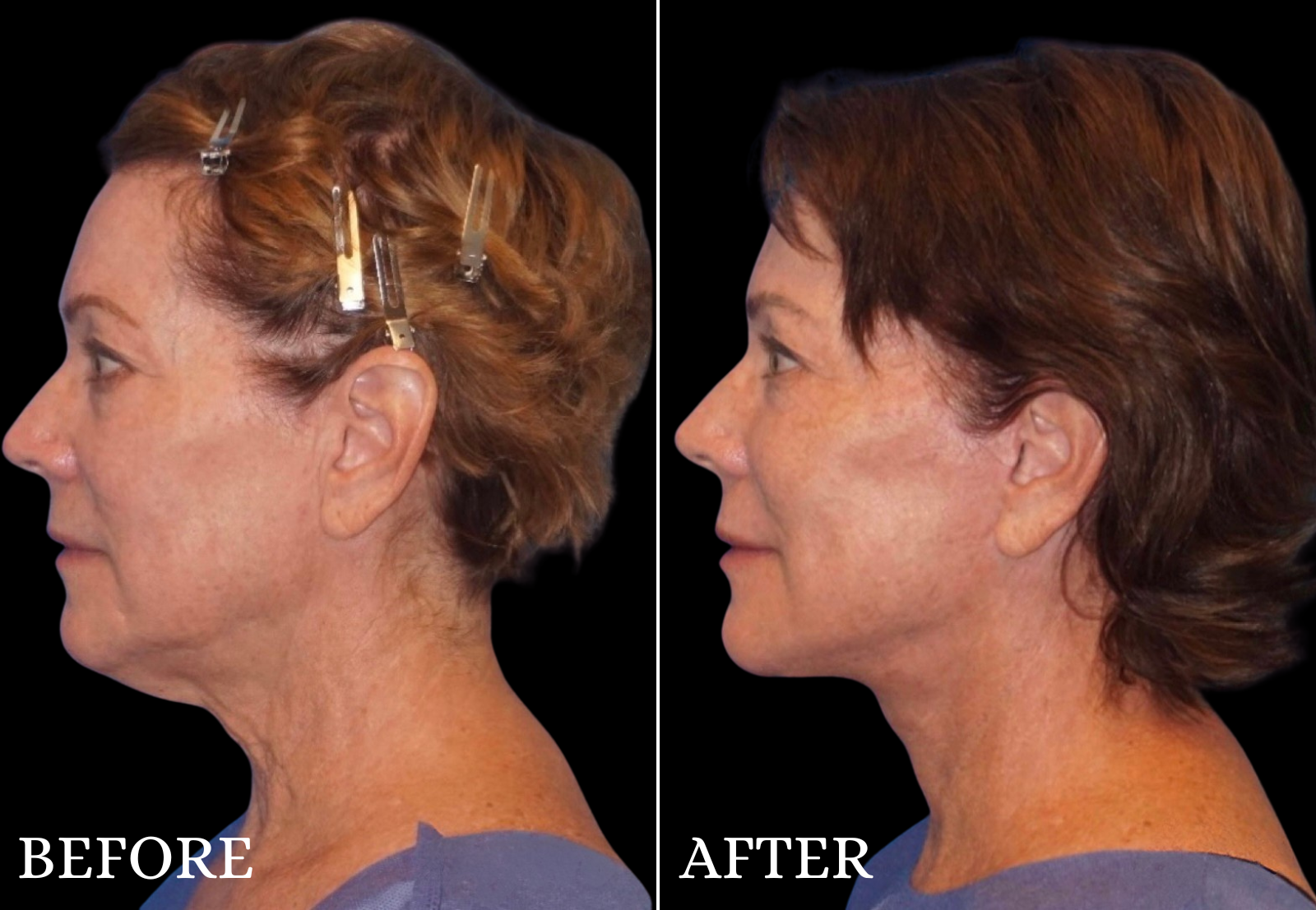 Neck Lift Before & After Gallery - Patient 299414 - Image 1